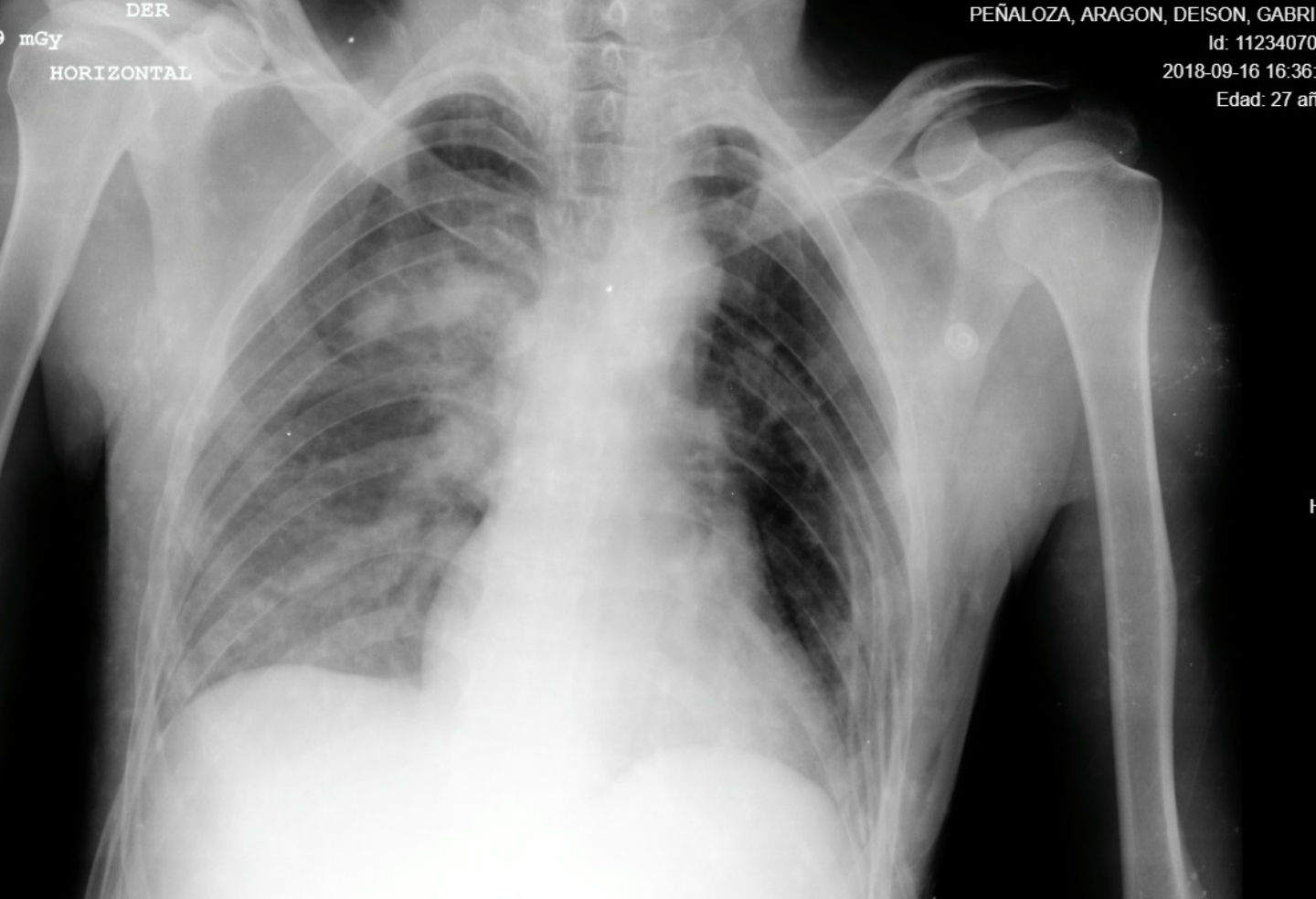El paciente ingresó a un centro asistencial inconsciente y con 98 % de probabilidades de morir.