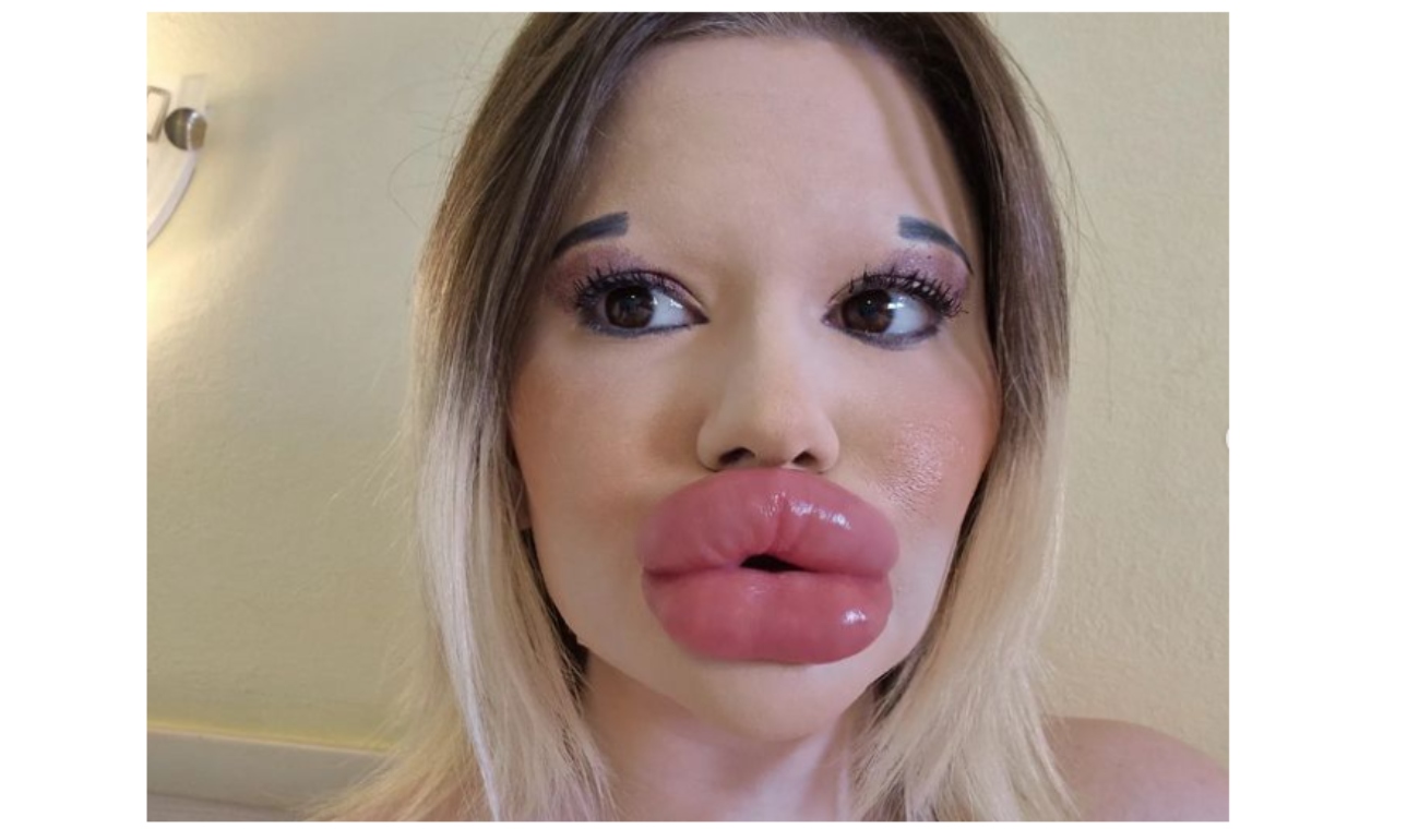 Mujer con los labios más gruesos del mundo no parará con inyecciones Mujer con los labios más gruesos del mundo no parará con inyecciones