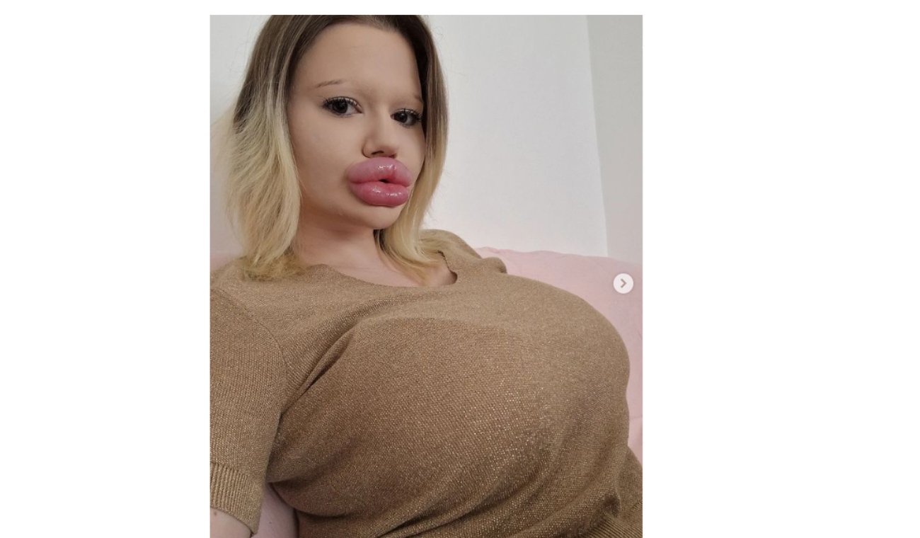 Mujer con los labios más gruesos del mundo no parará con inyecciones Mujer con los labios más gruesos del mundo no parará con inyecciones