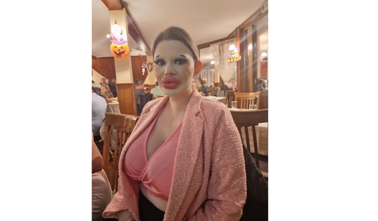 Mujer con los labios más gruesos del mundo no parará con inyecciones Mujer con los labios más gruesos del mundo no parará con inyecciones