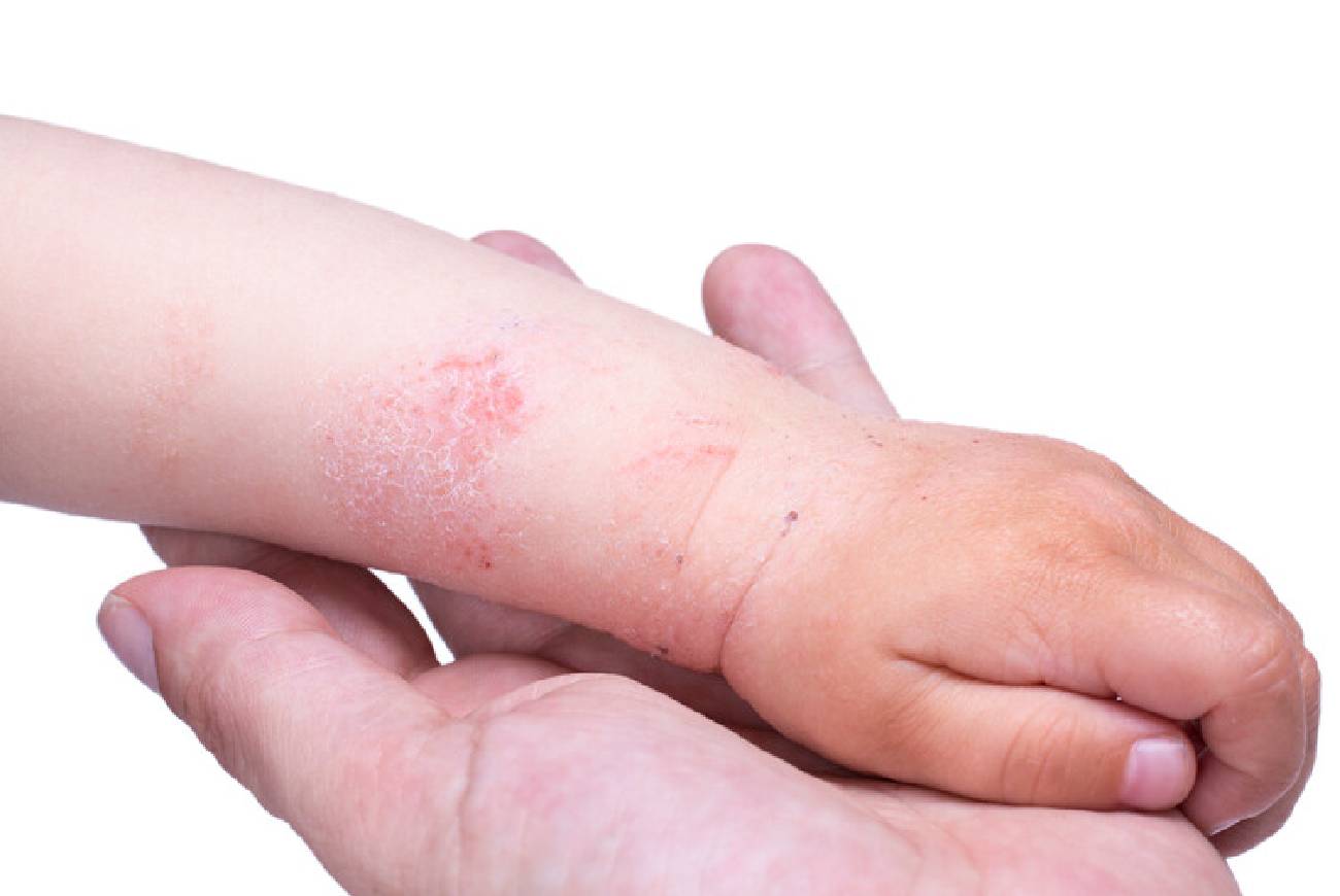 Brazo de bebé con dermatitis