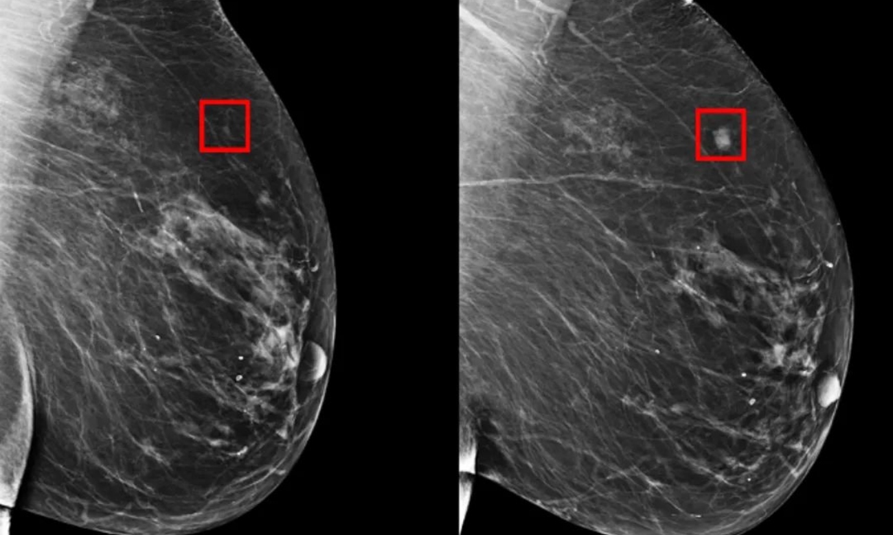 Breast Cancer May Be Predicted Five Years Prior to its Development, According to Scientific Discovery