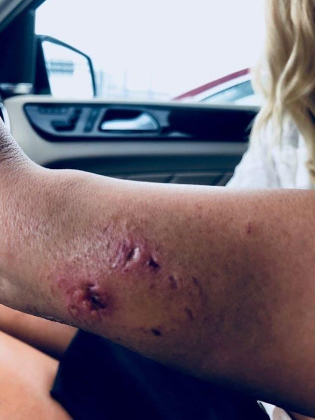 El brazo de la modelo después de las mordeduras. Thumbnail