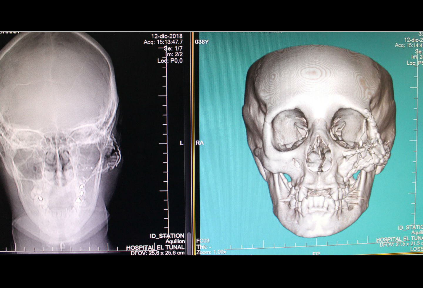 Reconstrucción de un rostro tras ser impactado por una bala