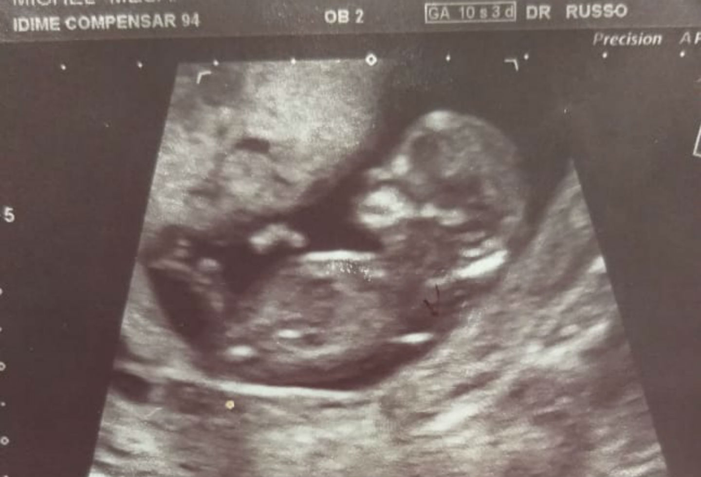 Ecografía de bebé con sindrome de down