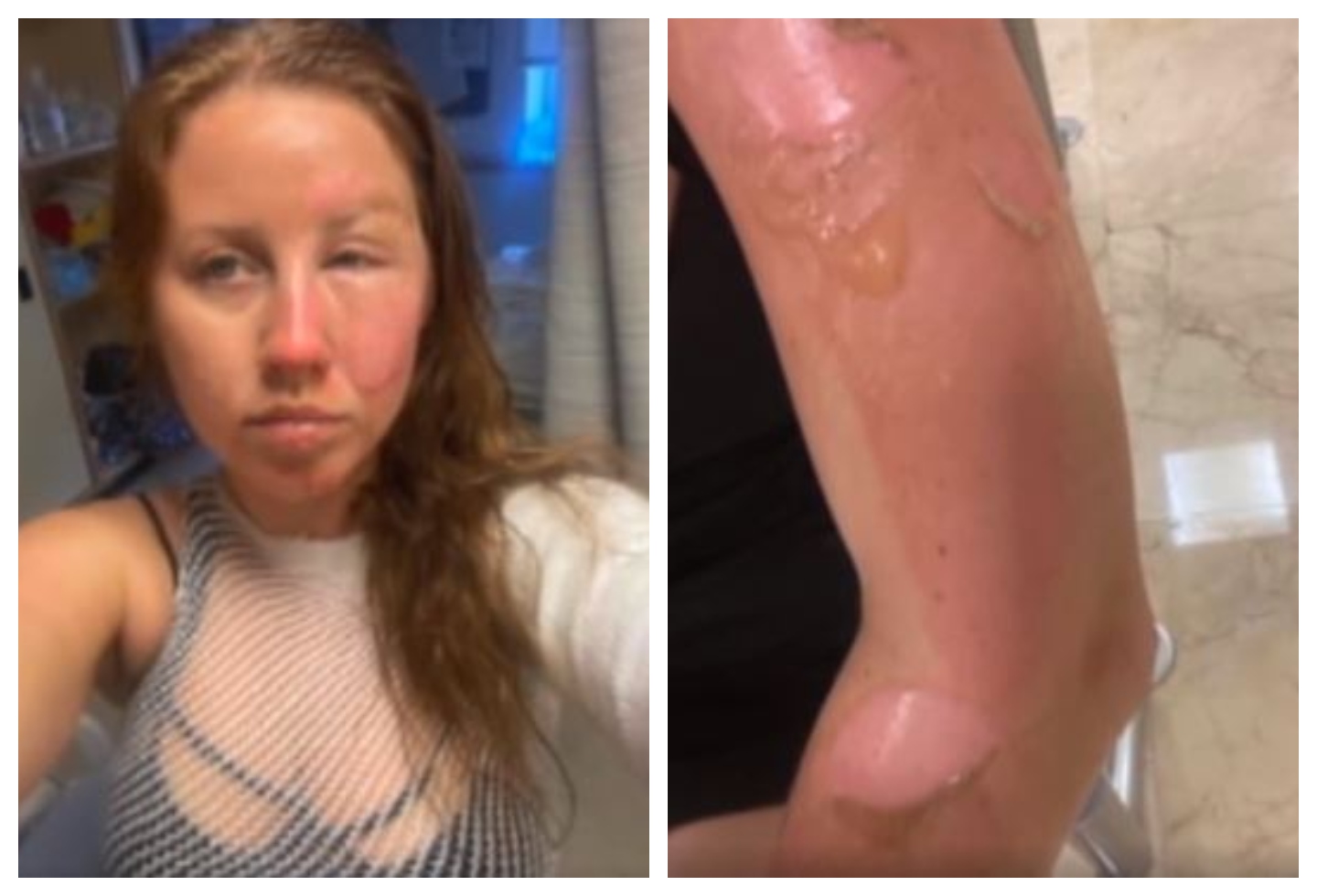 Turista quemada en Cancún con coctel flameado