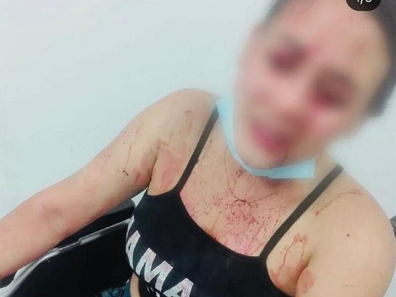 Mujer fue agredida con una botella dentro de un bar.