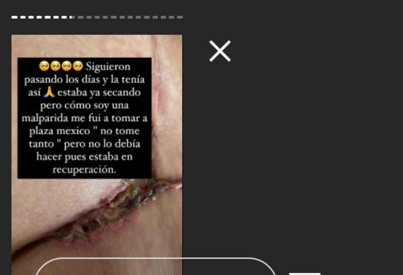 Cirugía a Yina Calderón
