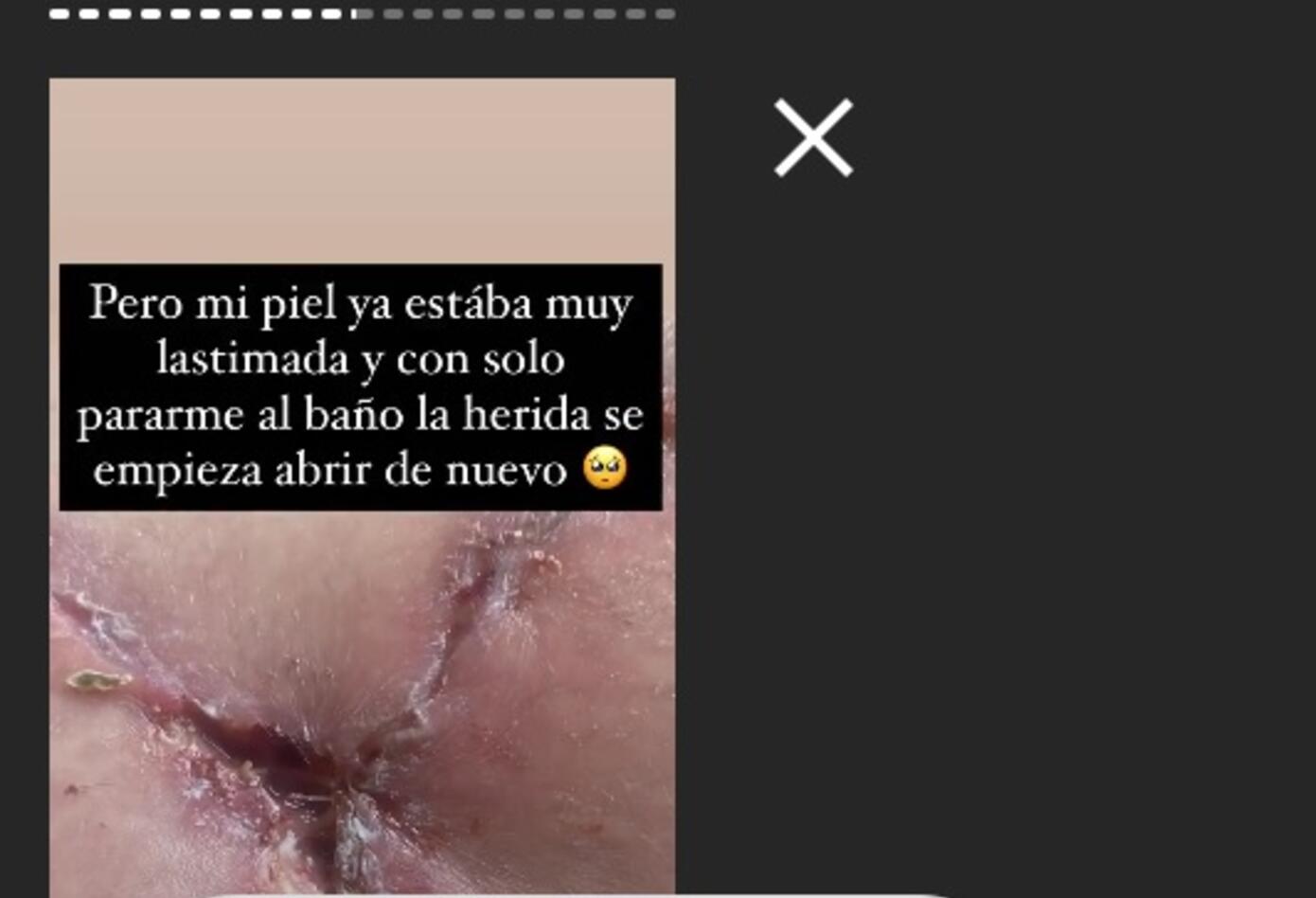 Cirugía a Yina Calderón