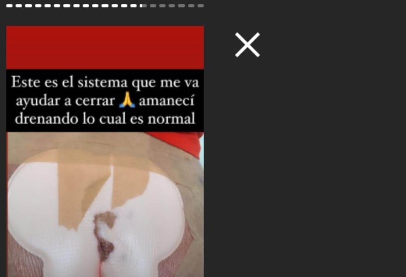 Cirugía a Yina Calderón