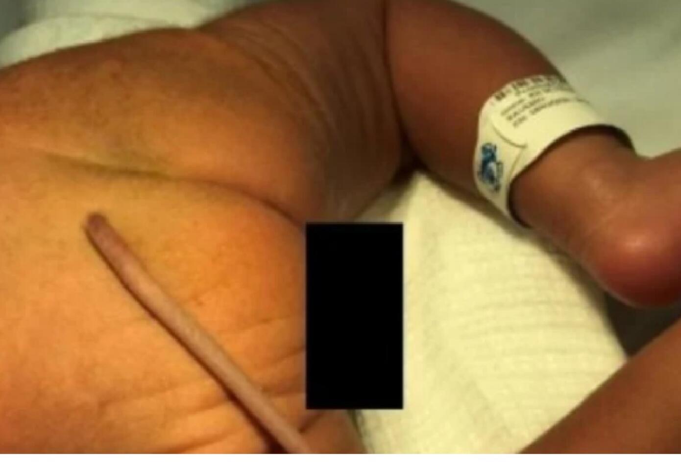 Bebé con cola de 12 centímetros