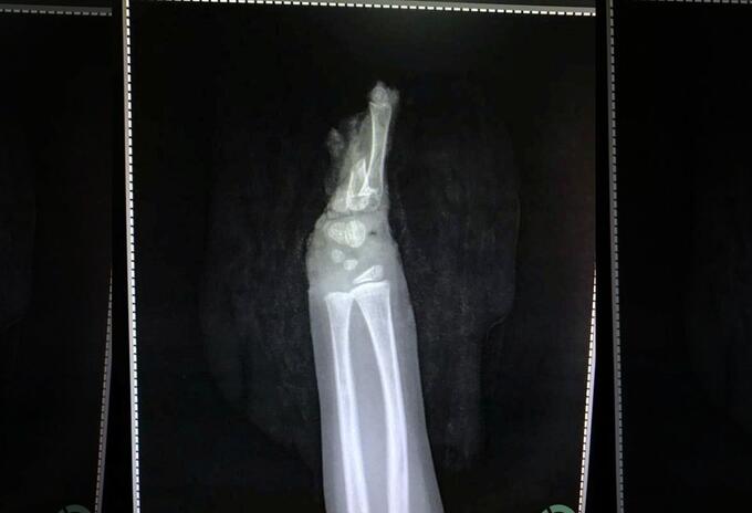 Niño se amputa una mano accidentalmente