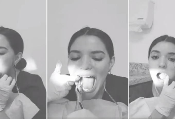 Dentista se saca las cordales sin ayuda