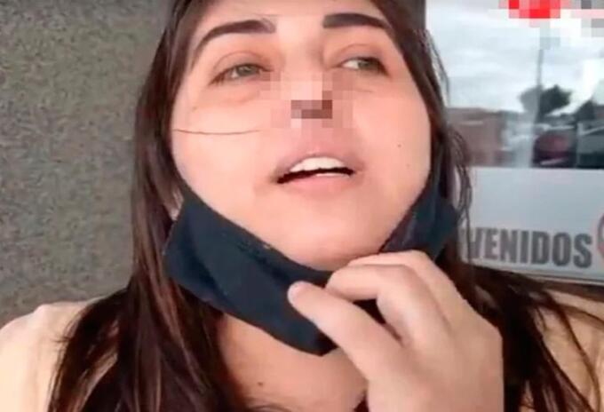 Mujer argentina que perdió el cartílago de su nariz