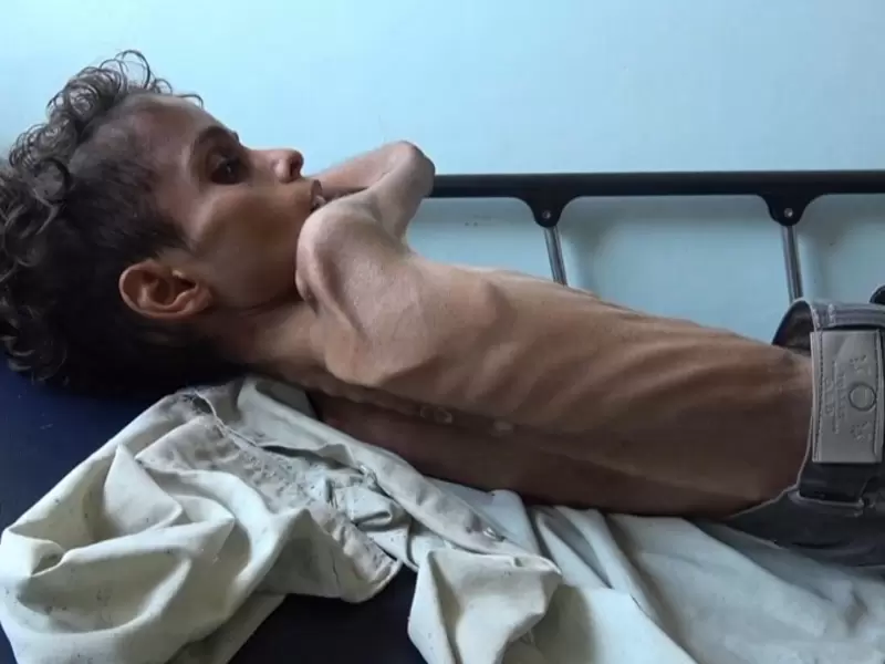 Niños hambre Yemen
