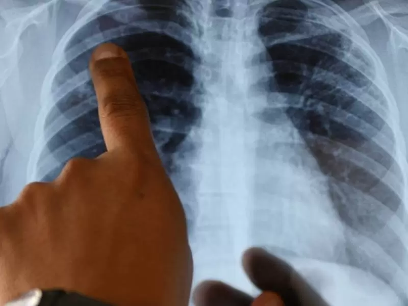 Los científicos han hecho grandes descubrimientos sobre lo que hace el coronavirus en los pulmones.