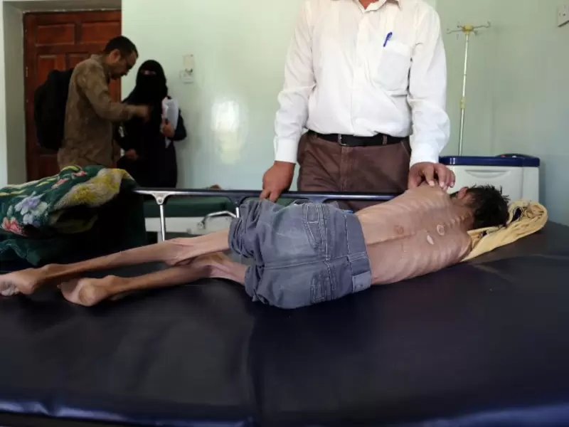 Yemen niños desnutridos Yemen niños desnutridos