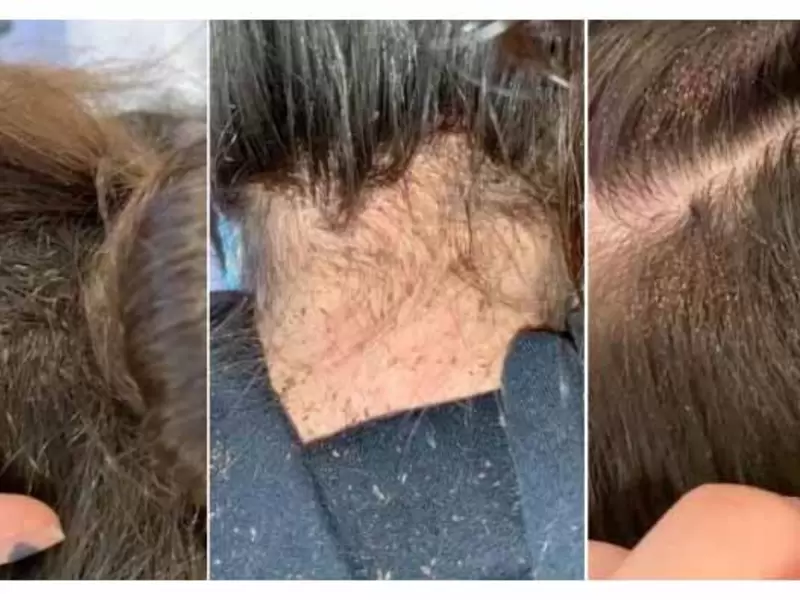 Piojos: niña de 12 años cundida