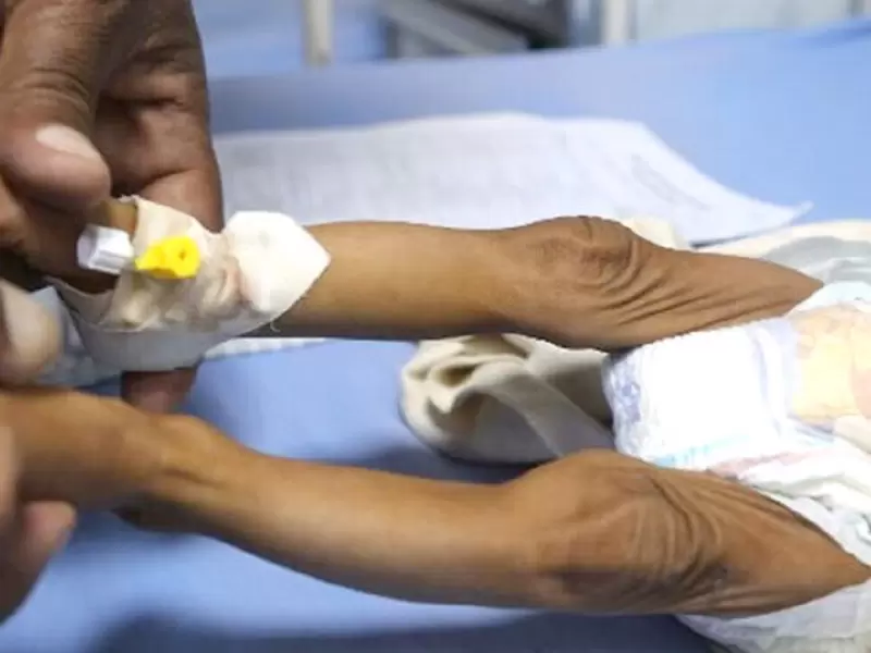 Niños mueren por desnutrición - referencial
