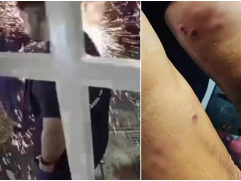 Familia resultó quemada por culpa de un volador que lanzó un vecino