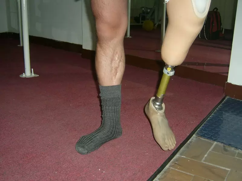 Prótesis3D Prótesis3D